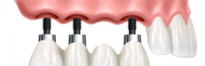 implant-supported-over-denture